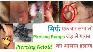 Piercing Keloid गायब करने का आसान व घरेलू उपाय l Home remedies for piercing keloid l Piercing Tips [upl. by Yenterb]