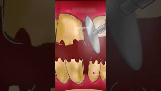 Teeth cleaning 🧼 asmr  SOHASMR [upl. by Charley]