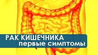 Симптомы рака кишечника Как проявляются первые симптомы рака кишечника Колопроктология [upl. by Tamara]