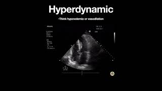 Hyperdynamic Left Ventricle Apical [upl. by Riay]