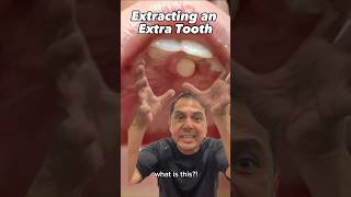 Pulling Out an EXTRA Tooth Explained Supernumerary Hyperdontia  View Mobile Dental shorts [upl. by Higinbotham]