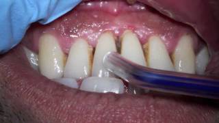 Severe gum disease advance periodontitis with smoking stain and pus between lower teeth [upl. by Nilats304]