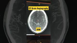 CT Brain Angiography Diagnosing AVM shorts trending viral radiology [upl. by Dahaf936]