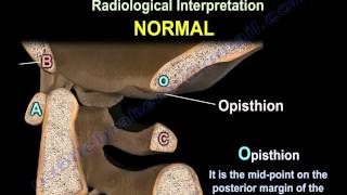 Occipitocervical Dislocation  Everything You Need To Know  Dr Nabil Ebraheim [upl. by Ynamad596]