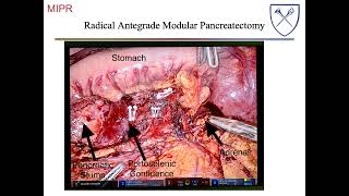 Distal Pancreatectomy [upl. by Annocahs]