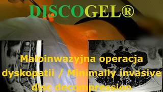 DISCOGEL® MAŁOINWAZYJNE PRZEZSKÓRNE LECZENIE DYSKPATII [upl. by Nawaj]