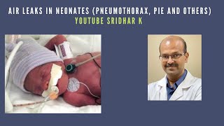 Air leaks in neonates pneumothorax PIE and others airleak pneumothorax neonatology [upl. by Avid]