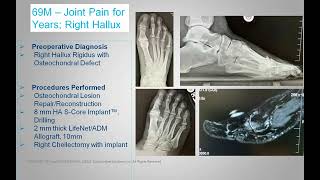 Joint Preservation Alternative Approaches to Treatment of 1st MPJ Degenerative Arthritis Batelli [upl. by Daniele]