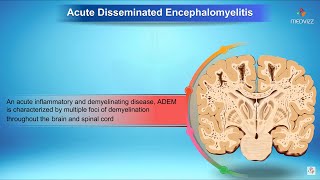 Acute disseminated encephalomyelitis  Neurology [upl. by Daffy604]