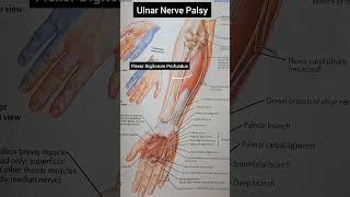 Ulnar Nerve Palsy [upl. by Gimble617]