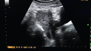 Complete bicornuate uterus USG Ultrasound [upl. by Rosemare]