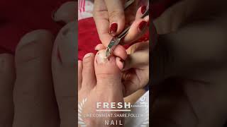 Toenail cleaning nailfungal toenailfungus toenails nailinfection viralvideo foryou [upl. by Ecnerolf40]