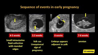 Early Pregnancy Failure A simplified Ultrasound Approach [upl. by Aibonez953]