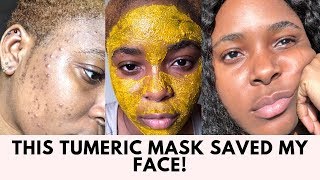 THE TUMERIC MASK THAT CLEARED MY ACNE SCARS AND HYPER PIGMENTATION [upl. by Jaala]