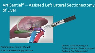 Artisential  assisted Left Lateral Sectionectomy [upl. by Dewees]