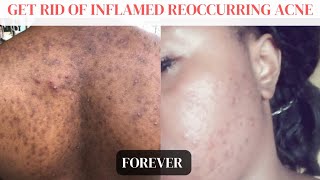 7 SUPER STEPS to Clear INFLAMED STUBBORN ACNE Get Rid of ACNE BREAKOUTS [upl. by Thorlie446]