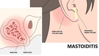 MastoiditisIntroduction of mastoiditis  Definition of mastoiditis Classification of mastoiditis [upl. by Conlee]