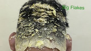 DRY SCALP  Big Flakes Dandruff Scratching Satisfying Video 768 [upl. by Tyler843]