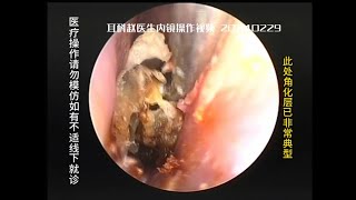 External auditory canal cholesteatoma with very narrow entrance 20240229 [upl. by Philbo53]