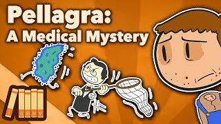 Pellagra  A Medical Mystery  Extra History [upl. by Aitel]