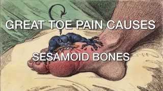 Dr Lakes Tips Great Toe Pain Causes  Sesamoid Bones [upl. by Ecadnarb]