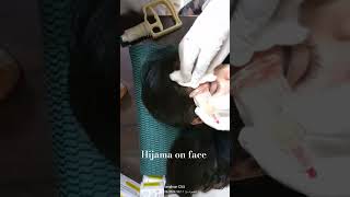 Hijama on face shorts viral youtubeshorts [upl. by Franchot]