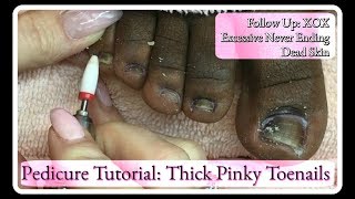 Excessive Never Ending Dead Skin Follow Up Pedicure Tutorial EFile Pinky Toenails [upl. by Dikmen]