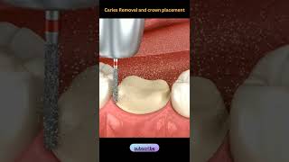 Caries Removal and Crown placementDentalhealth365 shorts shortsvideo dentist [upl. by Assetak]