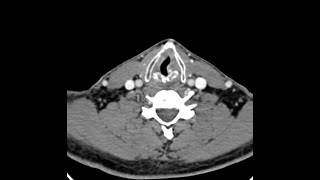 Teaching Rounds Locally Advanced Inoperable Oral Cancer [upl. by Aianat]