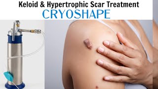 CRYOSHAPEfor the treatment of keloid scars [upl. by Robina795]