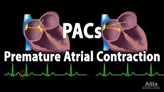 Premature Atrial Contractions PACs Animation [upl. by Ellesig876]