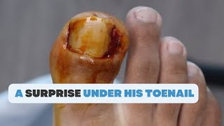 WHAT IS THIS SURPRISE UNDER HIS TOENAIL [upl. by Ada923]