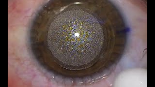 Actual SMILE eye laser vision correction procedure [upl. by Hepzi720]