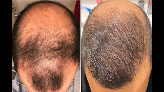 Hair transplant result in 6 months 4200 graft [upl. by Zora]