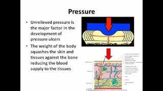 Preventing Pressure Ulcers a SKIN Bundle approach for Community Carers [upl. by Mcmaster]