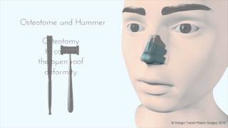 Breaking the Nose  Rhinoplasty Animation  Osteotomy [upl. by Nnyw]