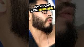 RESULTADO COM MINOXIDIL impressionante barba minoxidil [upl. by June94]