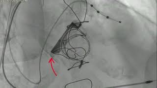 Dr Malik performs a Transcatheter Valve MITRAL ValveinValve TAVI shown at IVCC 2022 [upl. by Nnaj]