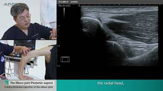 Musculoskeletal Ultrasound Elbow05 IntraArticular injection [upl. by Zetrom548]