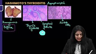 Hashimoto Thyroid Pathology For FMGE amp NEET PG INICET By Dr Preeti Sharma [upl. by Aznola]