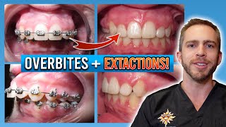 Braces Overbite Treatment BEFORE amp AFTER [upl. by Randene880]