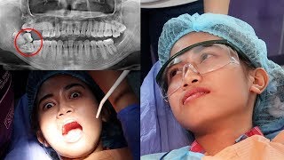 wisdom impacted teeth removal masakit ba [upl. by Rooney]