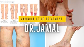 VARICOSE VEINS TREATMENTHIJAMA CURE [upl. by Yngiram]