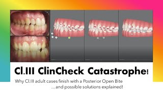 Invisalign ClinCheck  ClIII case problems amp how to solve Posterior Open Bite [upl. by Audrit]