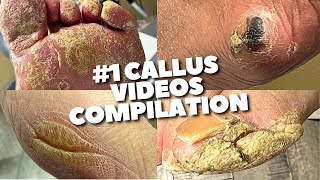 Super Crusty Callus Removal Compilation So Satisfying [upl. by Atnima877]