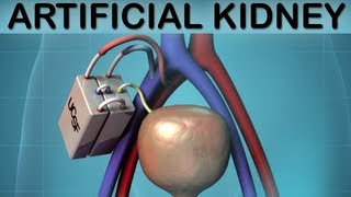 UCSF Artificial Kidney Medical Animation [upl. by Wurst]