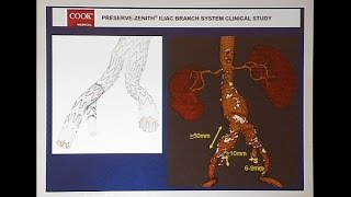 Hypogastric Artery Preservation When is it Necessary and HowIDoIt [upl. by Grevera]