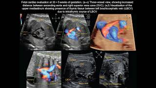 UOGJournal videoclip on fetal echocardiographic sign of intrathymic left brachiocephalic vein [upl. by March]