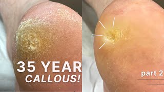 35 YEAR OLD CALLOUS 😱 Removing Callouses amp Super Deep Corns PART 2 [upl. by Ttam]