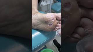 Treatment Callus and Dead skin Ep36 Sheng Clinic [upl. by Gertie]